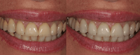 Igiene orale prima e dopo