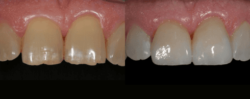 Sbiancamento dentale prima e dopo
