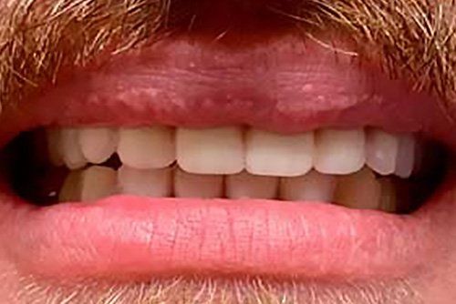 Implant Retained Snap-On After