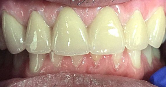 Before Full Dental Crown and bridge