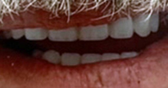 After full dental implants