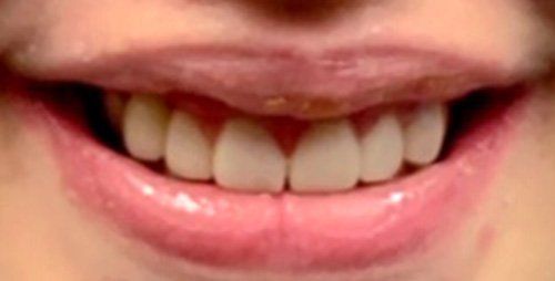 After dental crowns