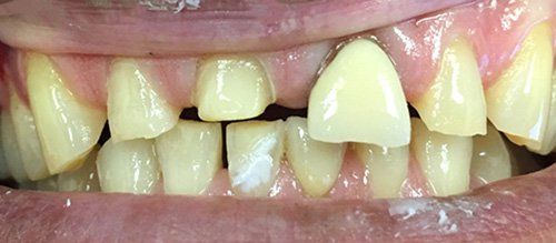 Before Full Dental Crown and bridge