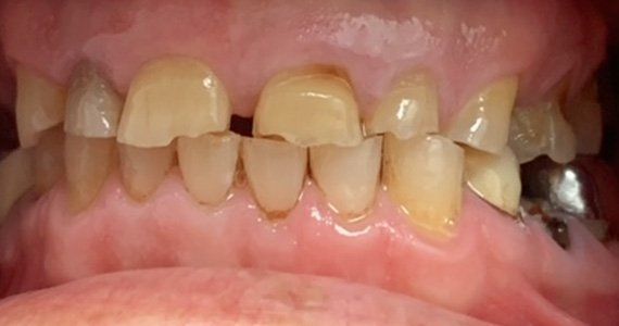 Before full dental implants