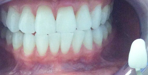 After Zoom Whitening