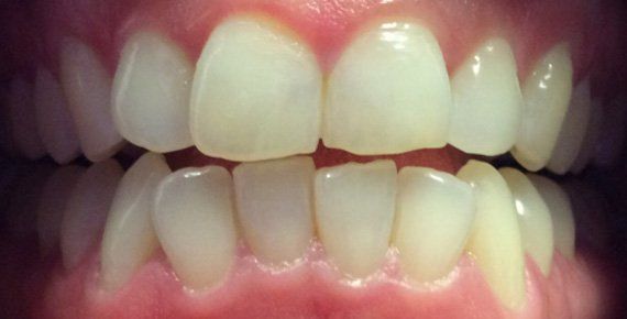 Before Zoom Whitening