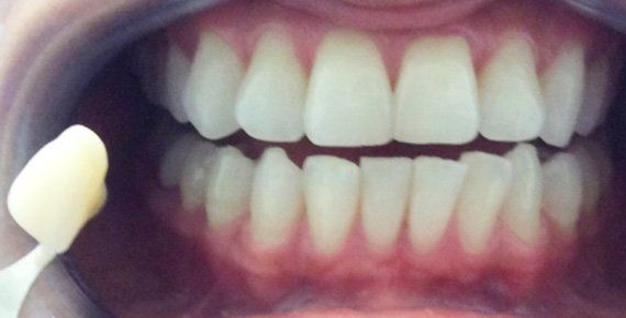 Before Zoom Whitening
