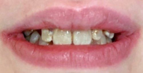 Before dental Crowns