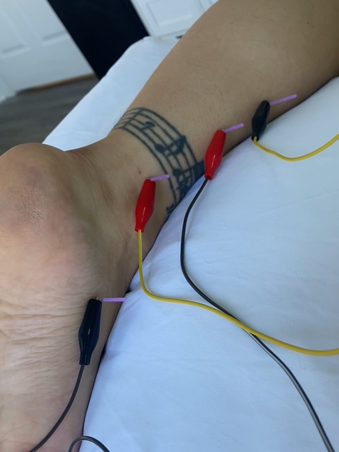 Dry needling for foot pain, plantar fasciitis, shin splints