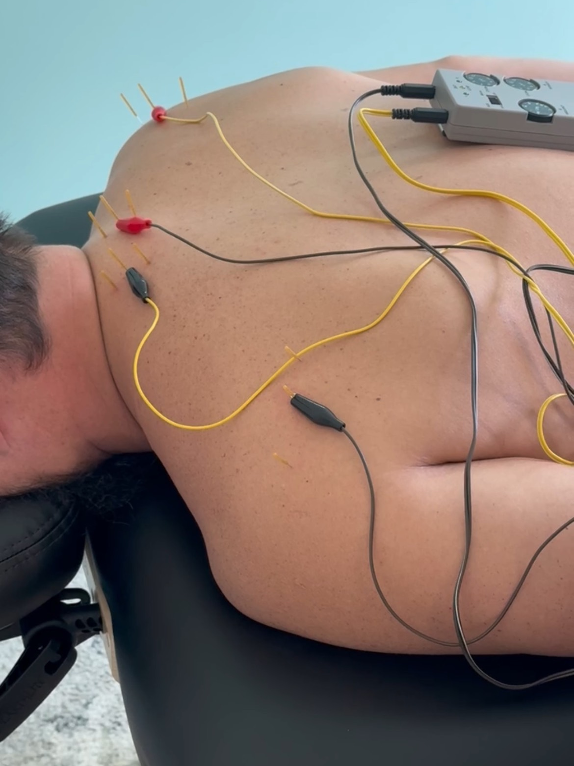 Dry needling for neck and back pain with E-STim