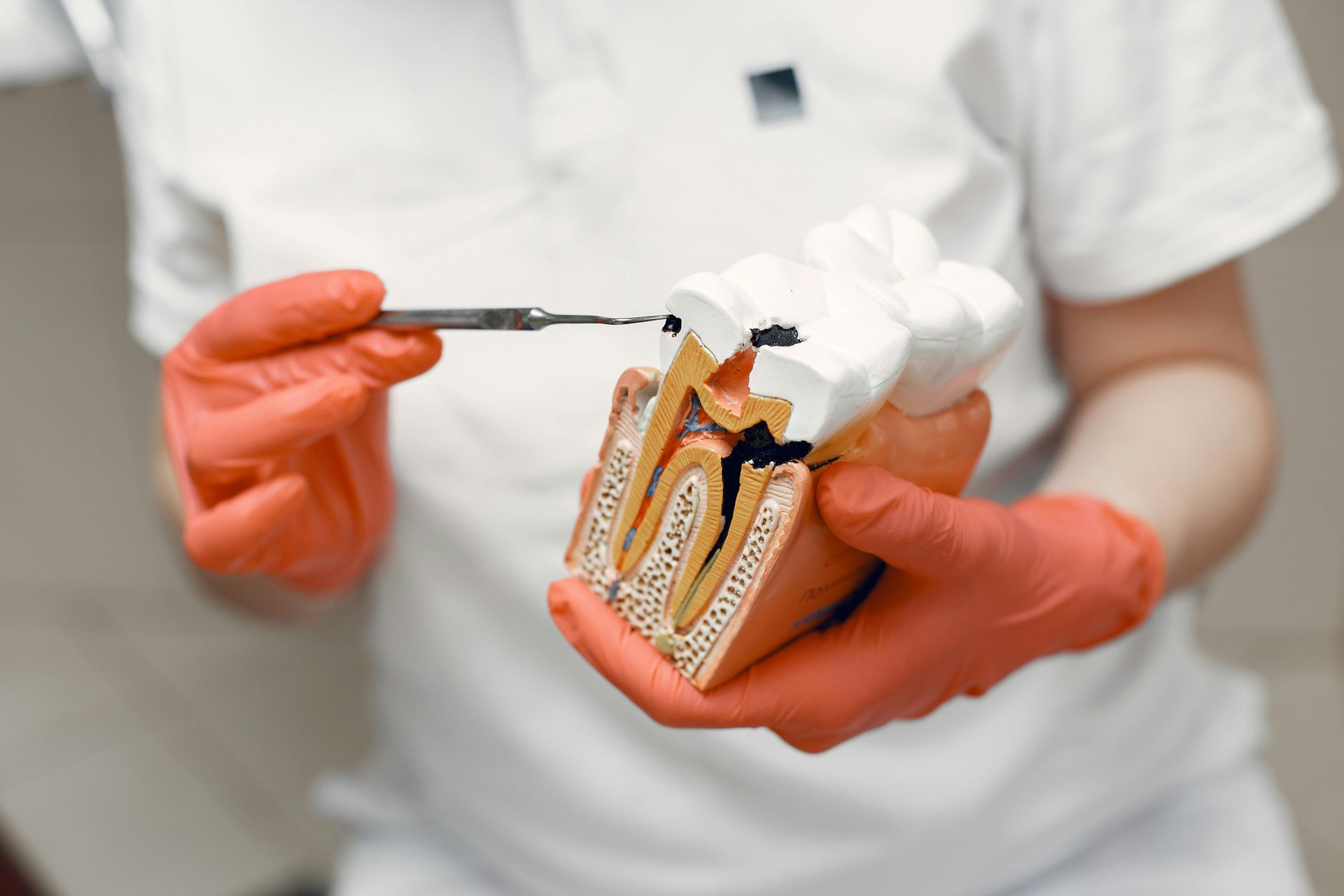 Dentist holding a model of a tooth with decay, pointing with a dental tool, wearing gloves.
