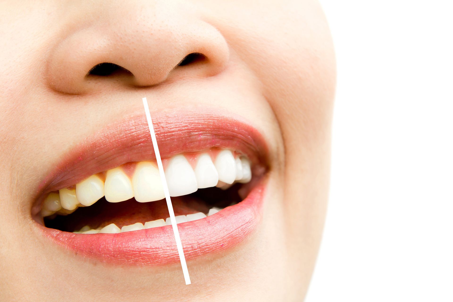 Woman's teeth comparison: left side yellow, right side white, divided by a vertical line.