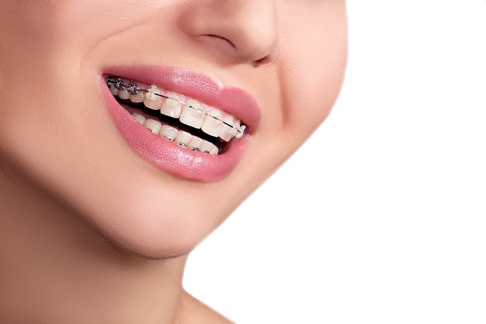 A Close Up of a Woman 's Mouth With Braces on Her Teeth — Advanced Dental Southern Highlands in Moss Vale, NSW