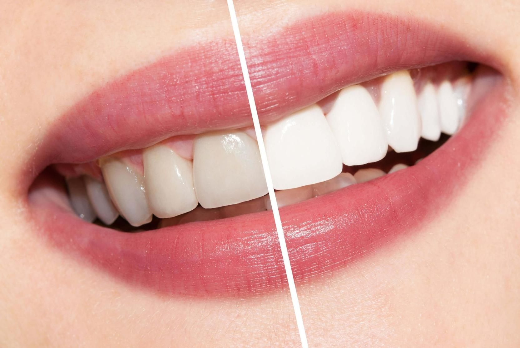 A Before and After Photo of A Woman's Teeth — Advanced Dental Southern Highlands in Moss Vale, NSW