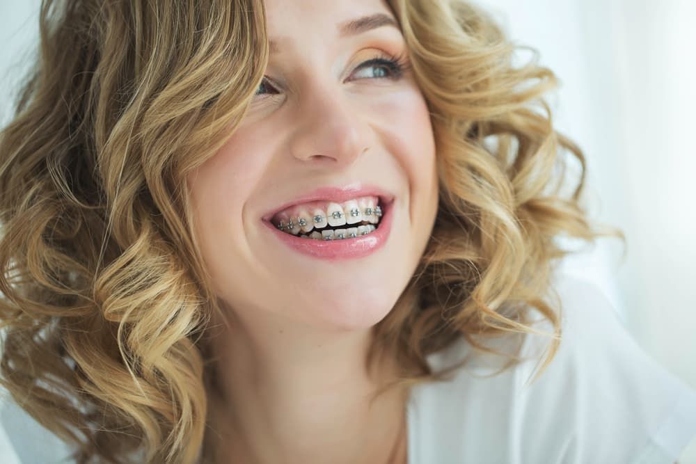A Woman With Braces on Her Teeth is Smiling — Advanced Dental Southern Highlands in Moss Vale, NSW