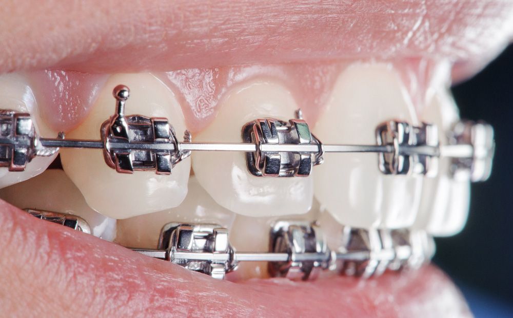 A Close Up of a Person's Teeth With Braces — Advanced Dental Southern Highlands in Moss Vale, NSW