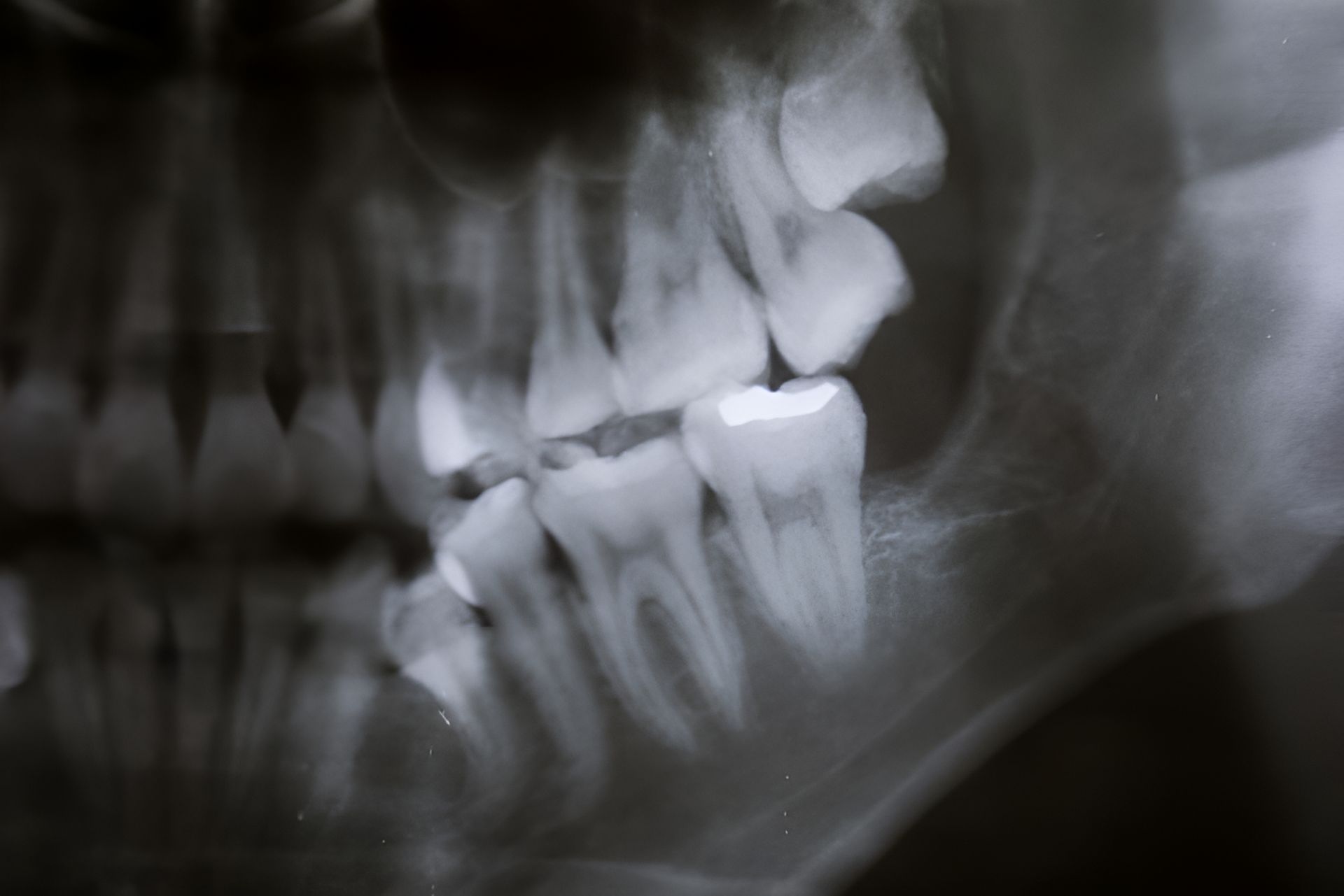 Dental X-ray of Teeth and Roots — Advanced Dental Southern Highlands in Moss Vale, NSW