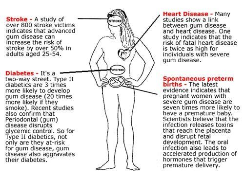 Gum disease diagram — Professional Dentistry in Salt Lake City,UT