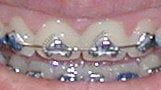 Metal brackets — Professional Dentistry in Salt Lake City,UT