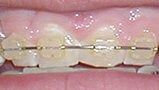 White brackets — Professional Dentistry in Salt Lake City,UT