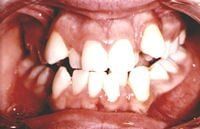 Before  — Professional Dentistry in Salt Lake City,UT