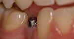Implant — Professional Dentistry in Salt Lake City,UT