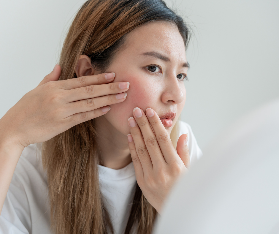 Rosacea Treatments | Eye Foundation of Utah