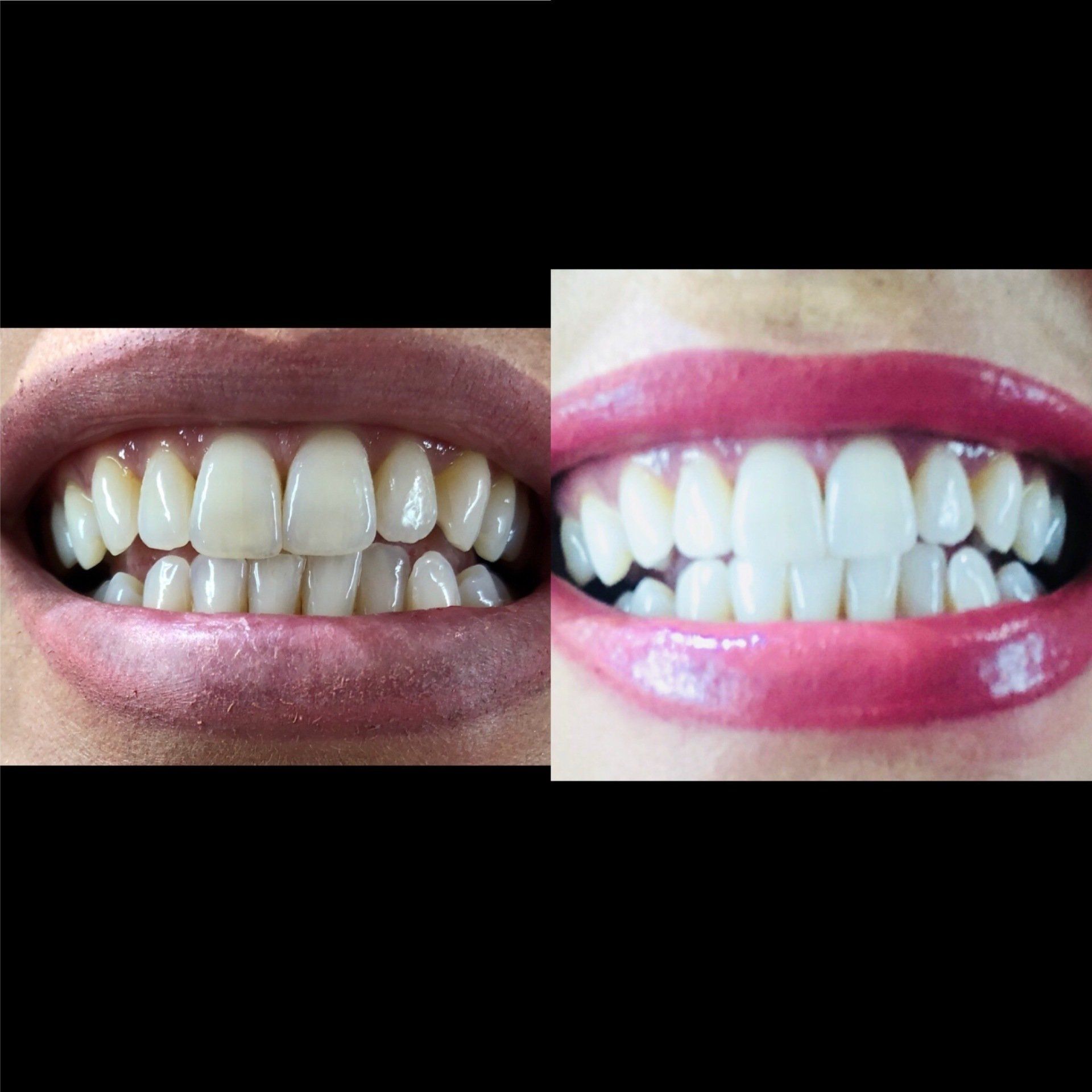 Ein Vorher-Nachher-Bild der Zähne einer Frau
