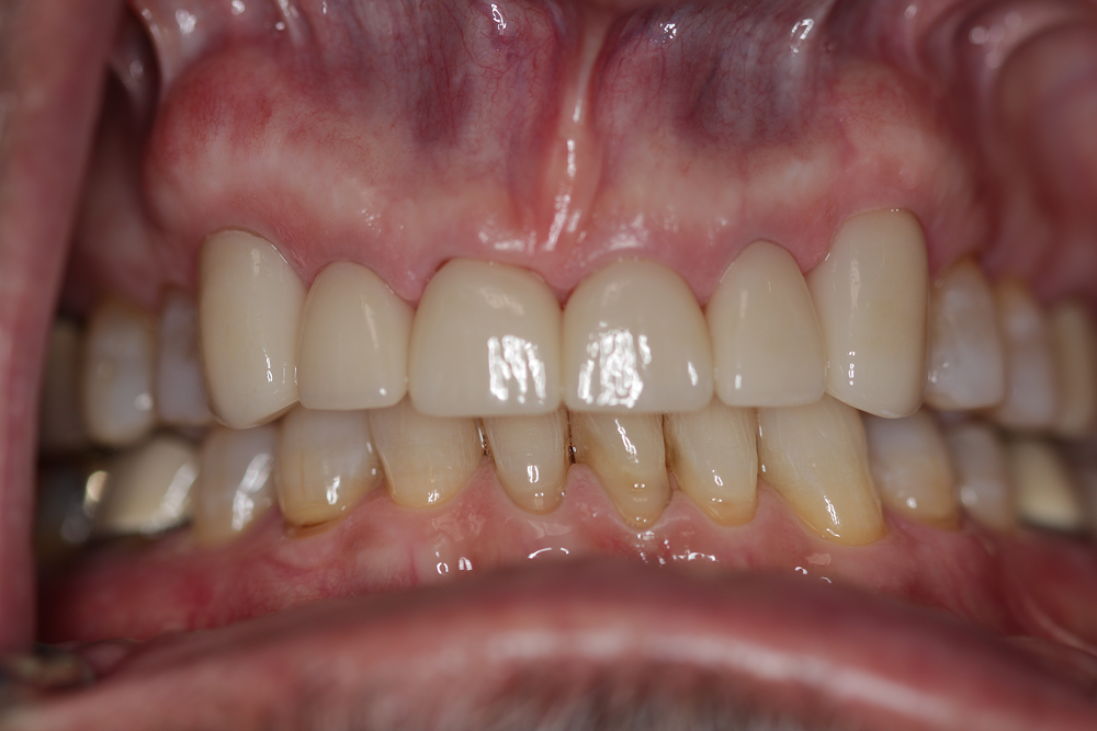 Close-up of human teeth, showing both upper and lower sets. Some teeth are capped, others are natural.