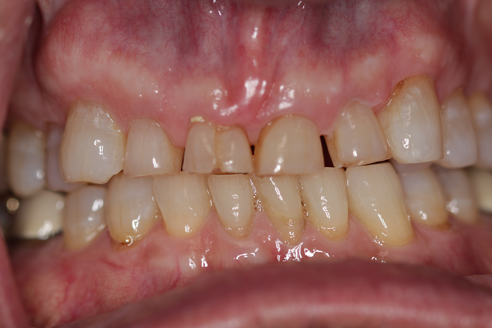 Close-up of teeth showing worn enamel, chips, and receding gums.