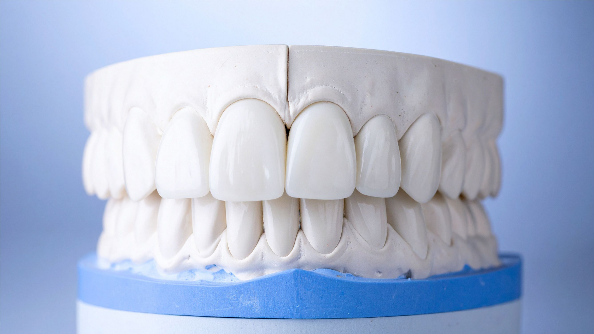 Dental model with white ceramic veneers, on a blue and white base, against a blue background.