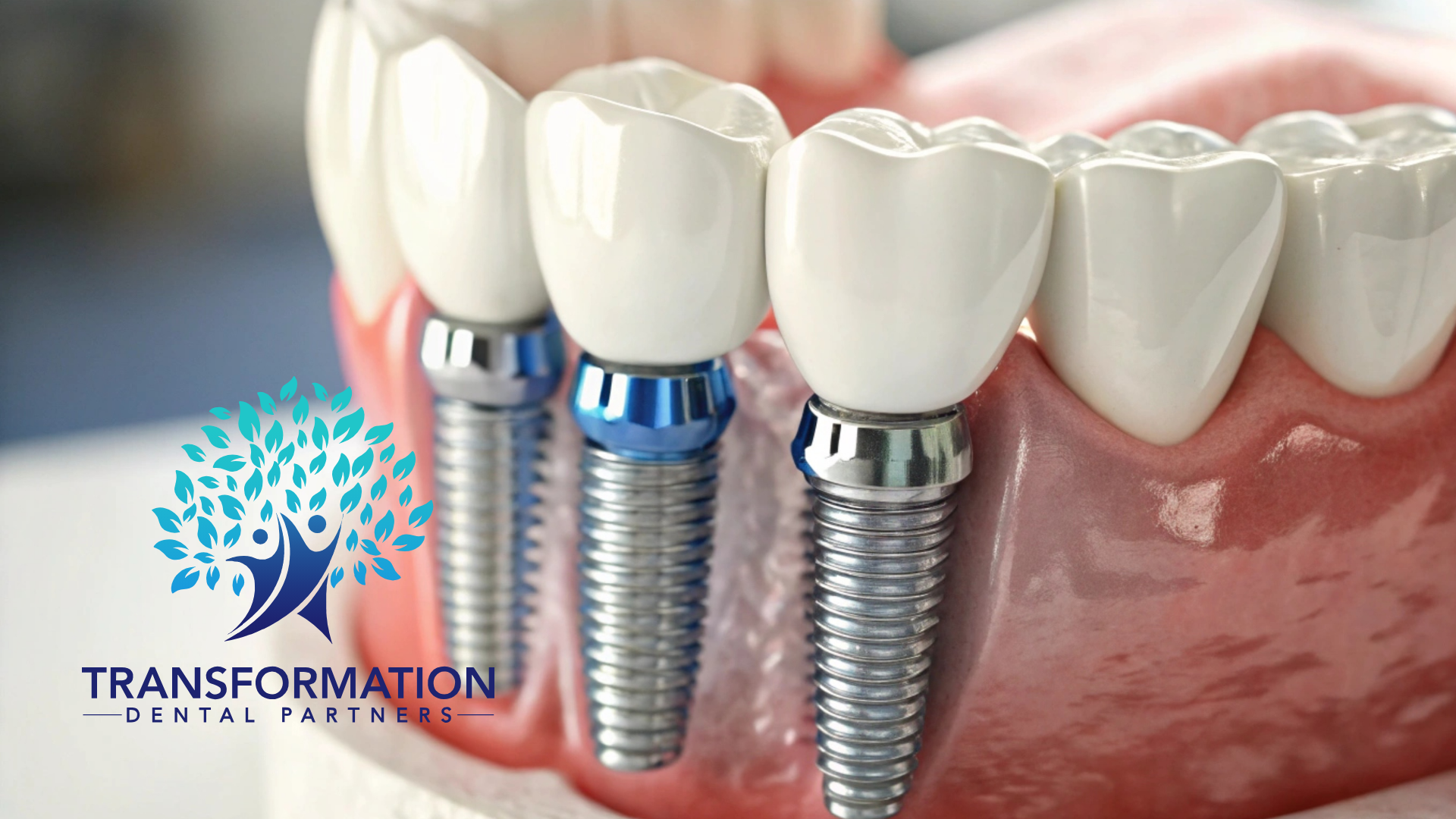 Model of dental implants in a mouth, showcasing titanium posts and white crowns.