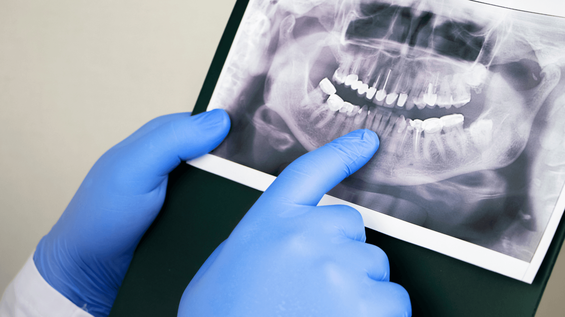 A dentist is pointing at an x-ray of a person 's teeth.