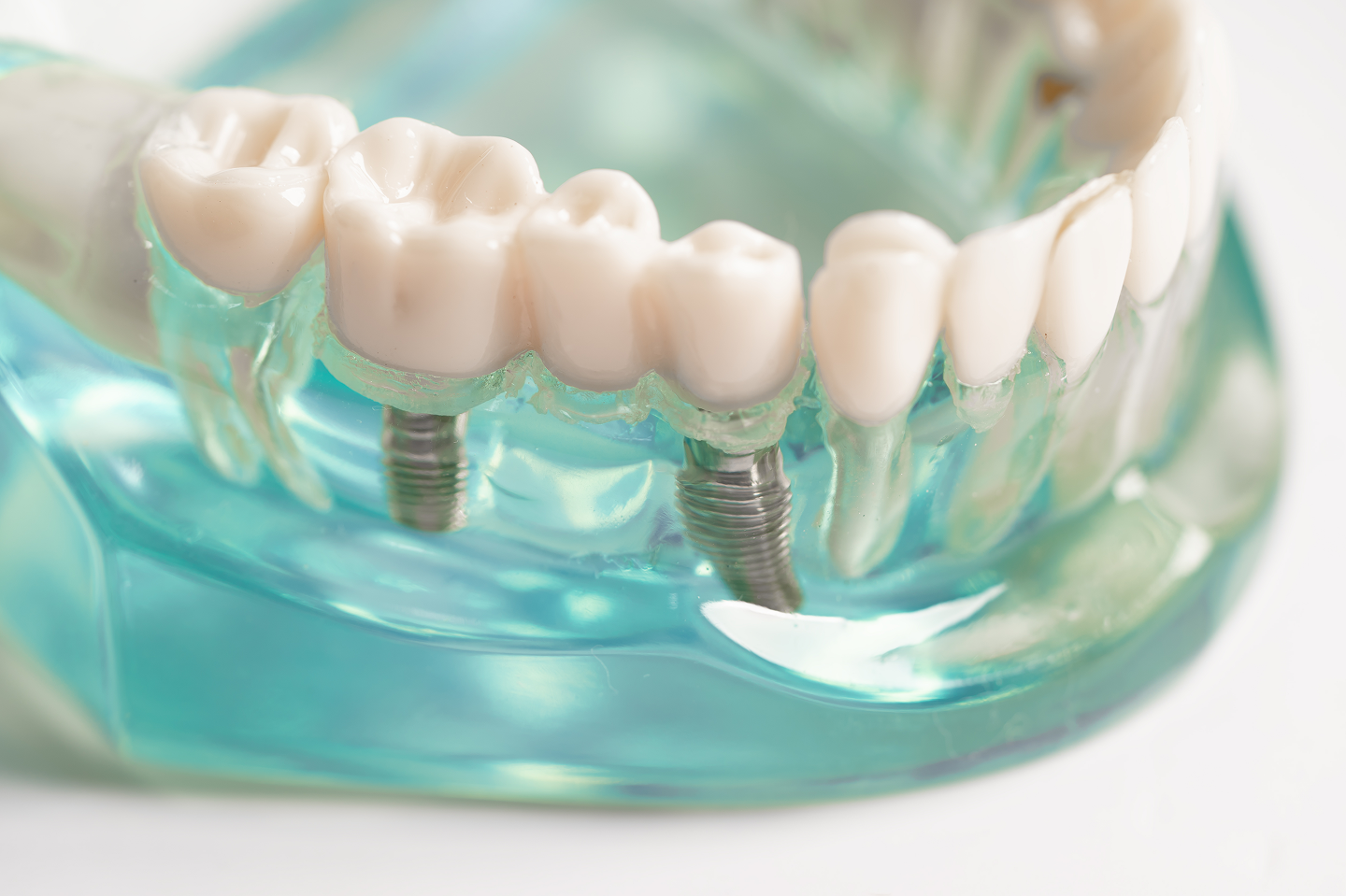 A close up of a model of teeth with dental implants.