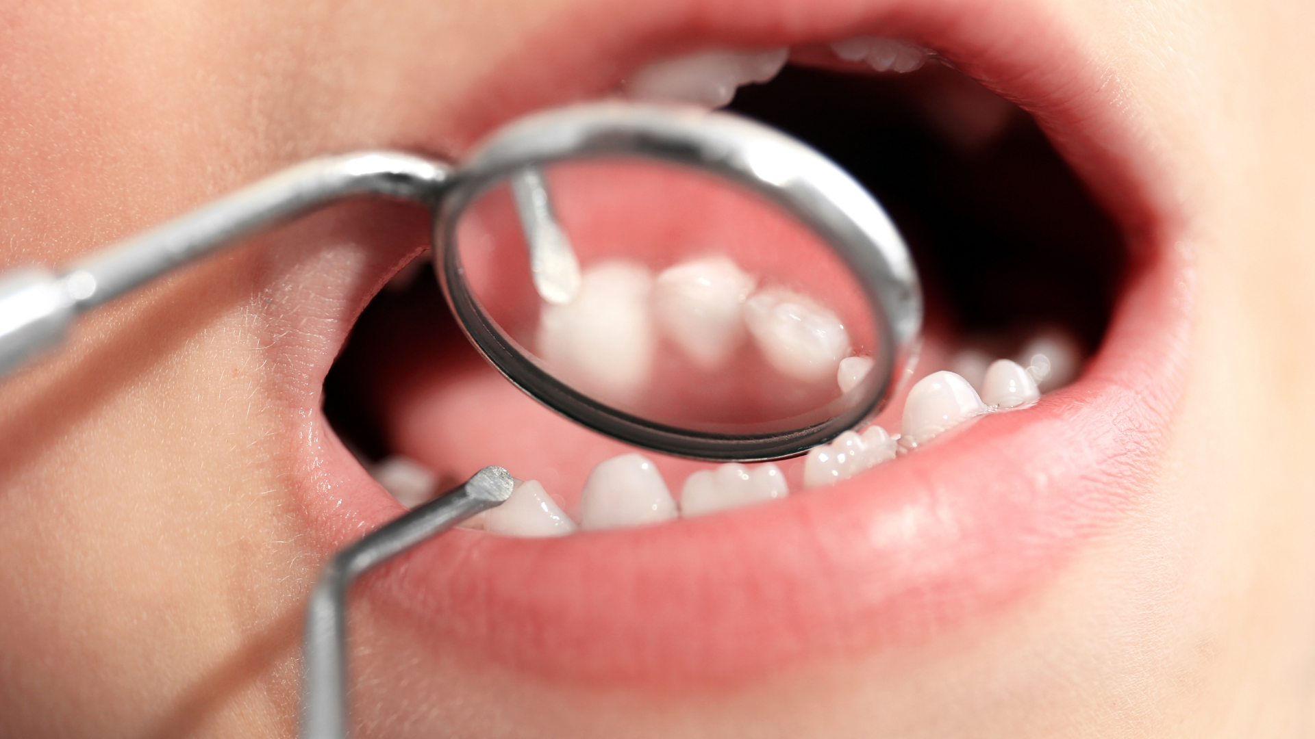 A person is getting their teeth examined by a dentist.
