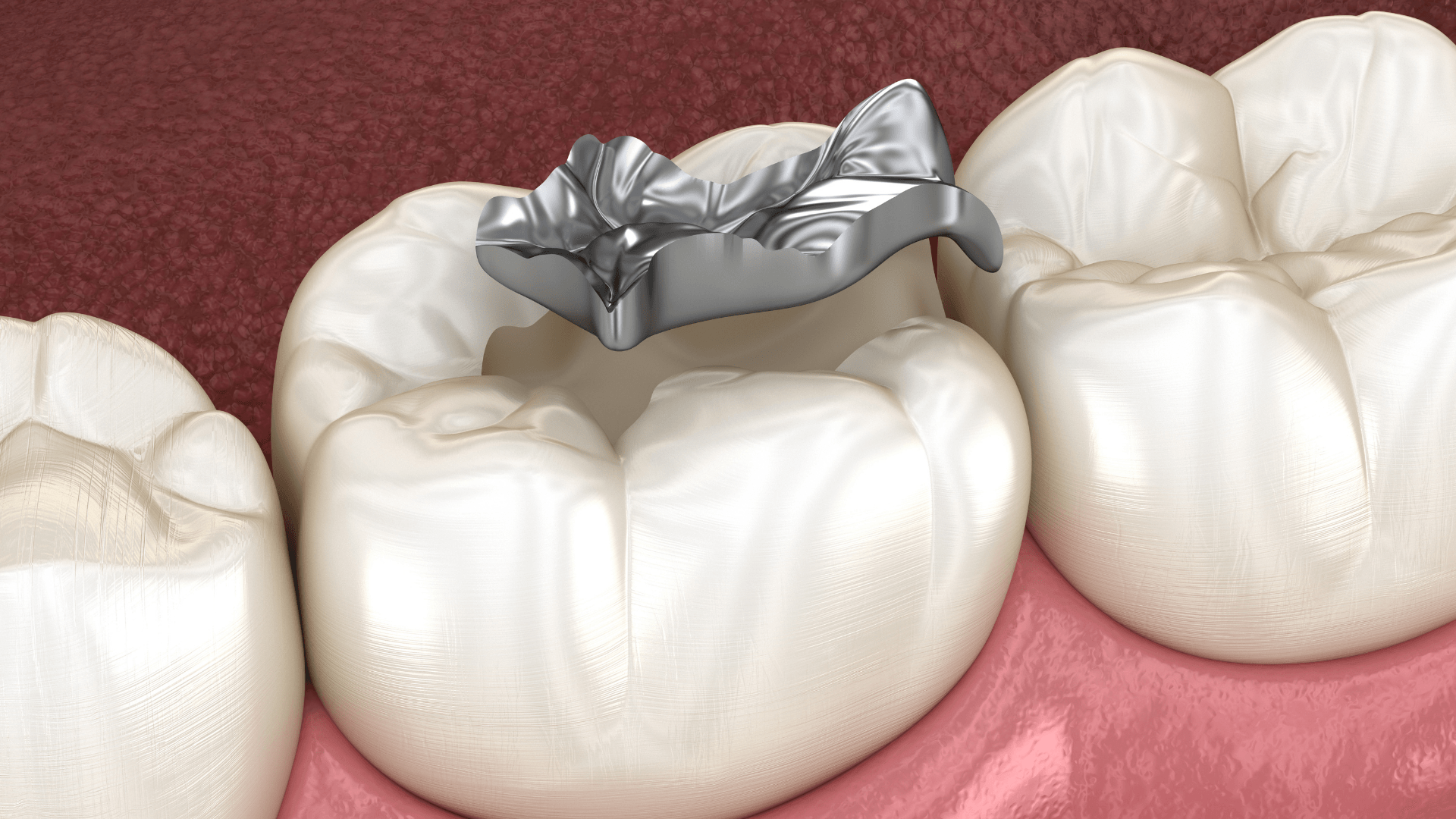 A close up of a tooth with a metal filling in it.