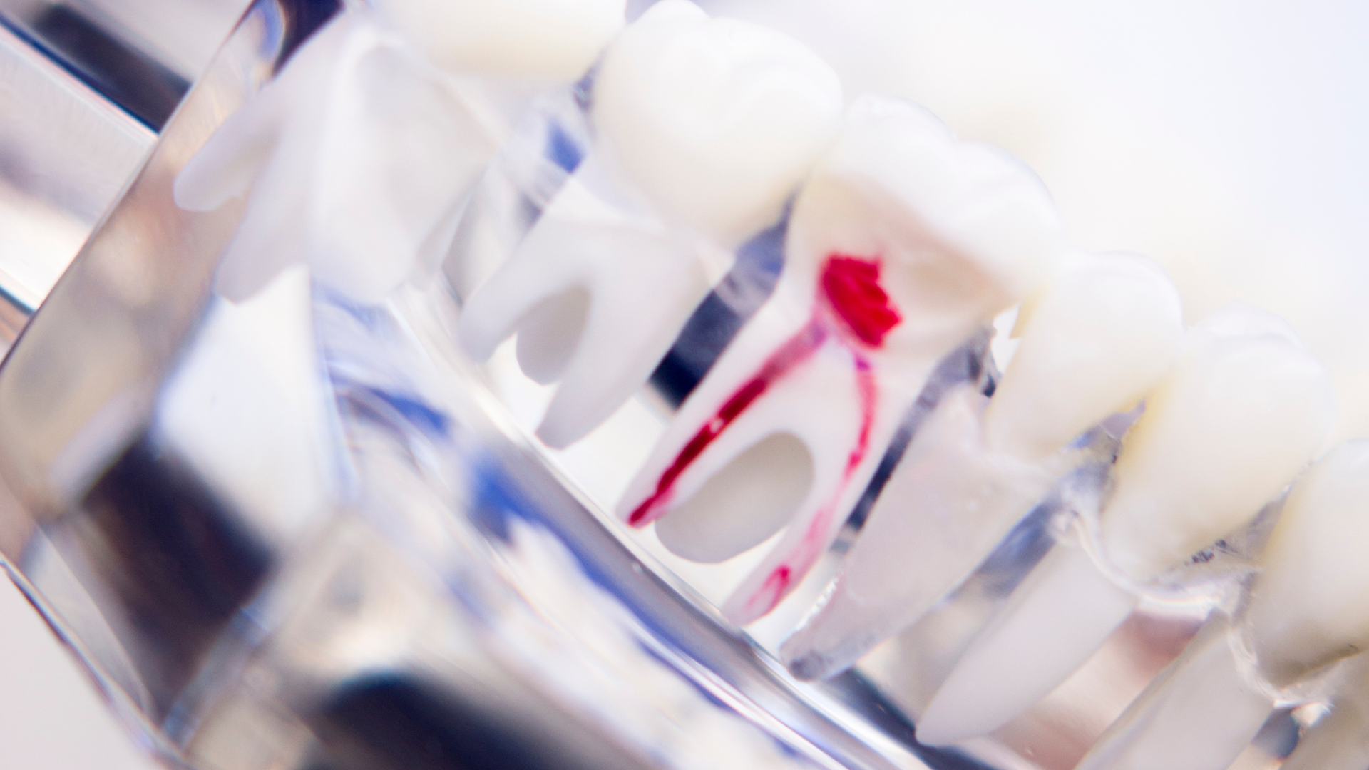 A close up of a model of a tooth with a hole in it.
