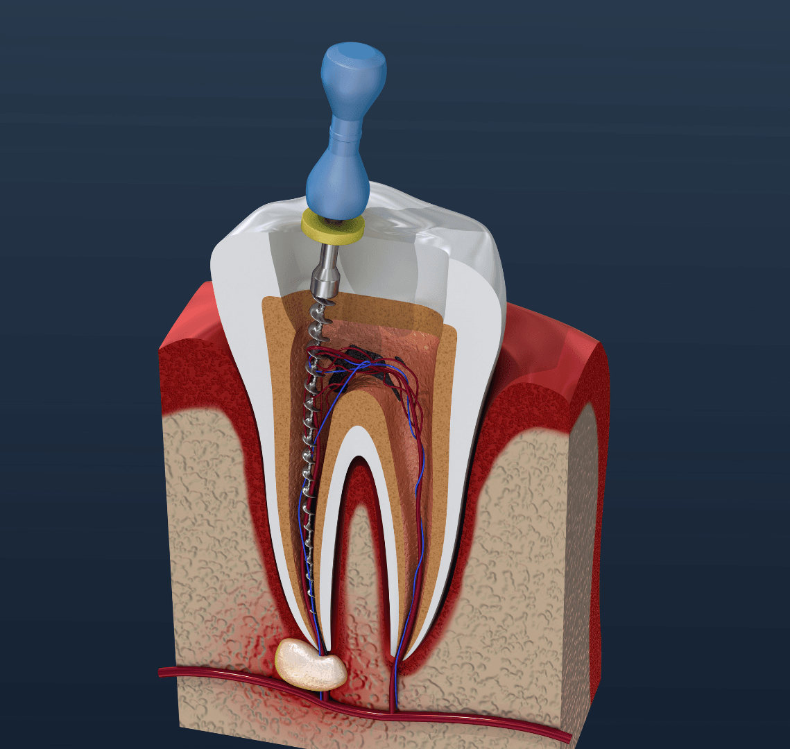 A model of a tooth with a drill in it