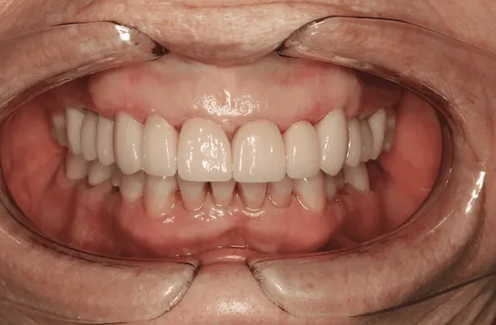 A close up of a person 's teeth with a mouth guard.