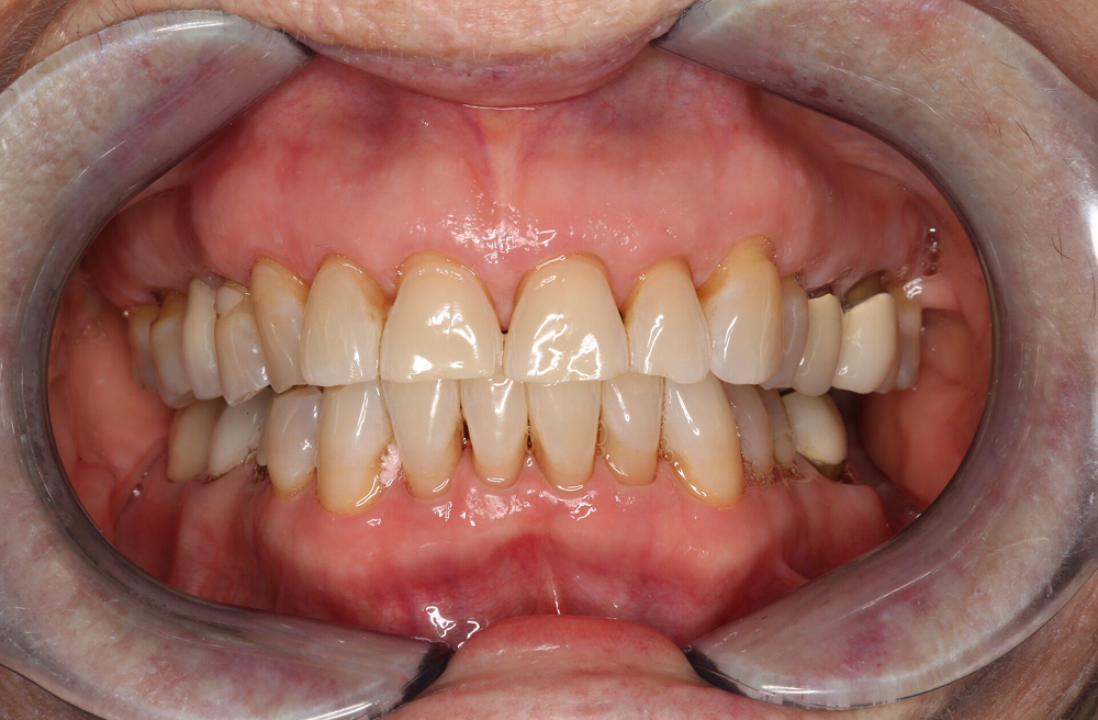 A close up of a person 's teeth with a mouth guard.