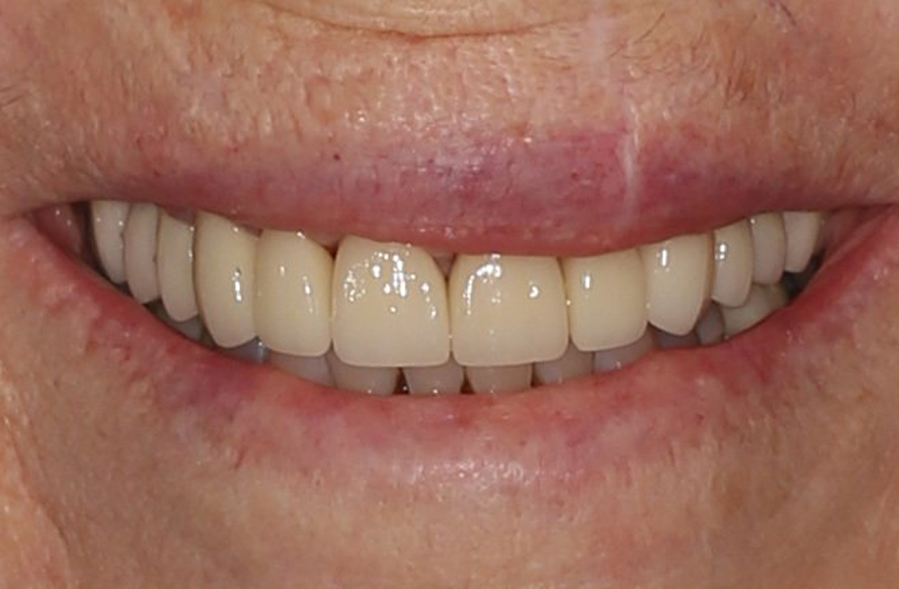 A close up of an elderly woman 's smile with white teeth.