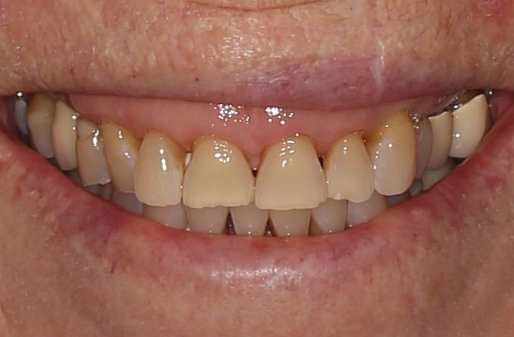 A close up of a person 's teeth with a smile on their face.