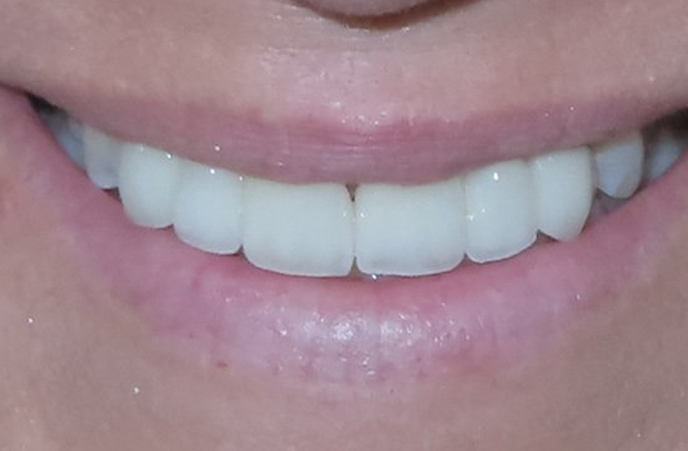 A close up of a woman 's smile with white teeth.