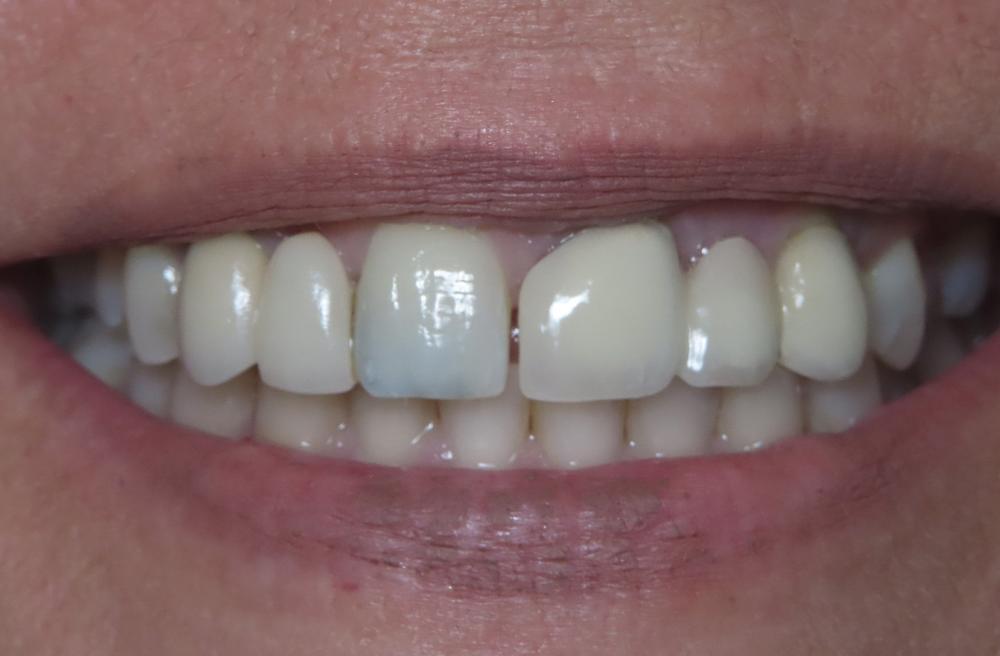 A close up of a person 's teeth with a missing tooth.