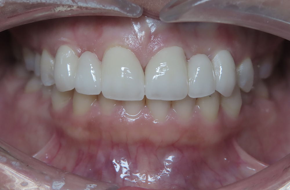 A close up of a person 's teeth with a clear mouth guard.