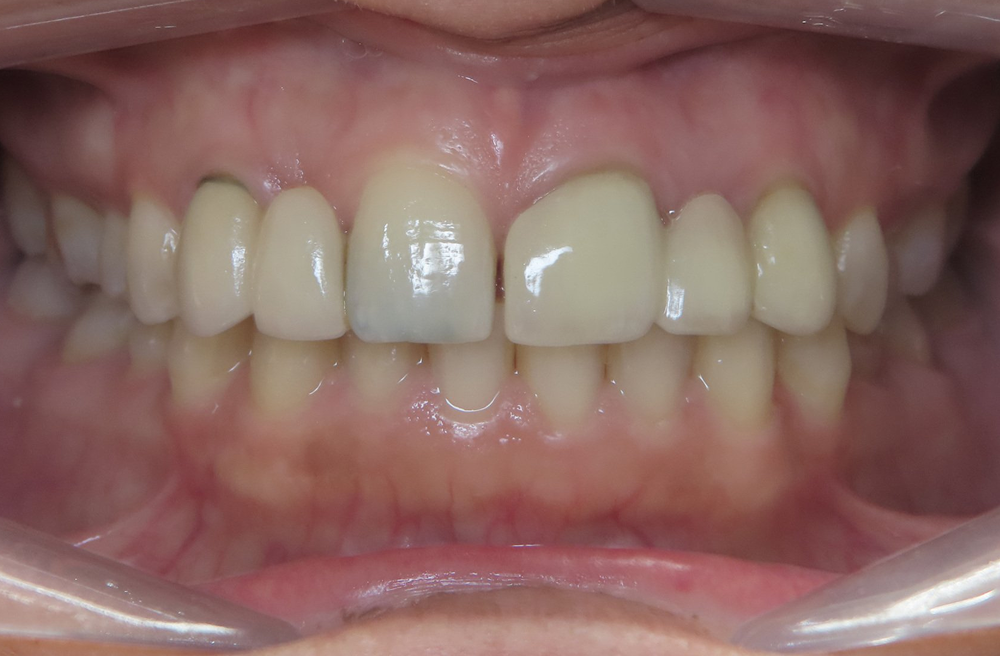 A close up of a person 's teeth with a missing tooth.