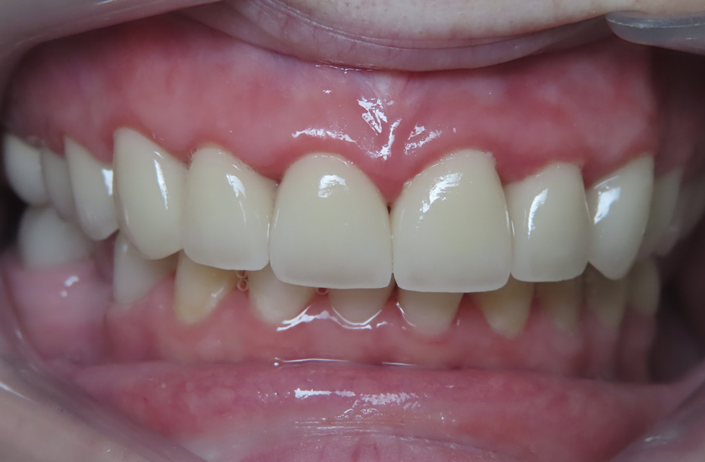 A close up of a person 's teeth with braces.