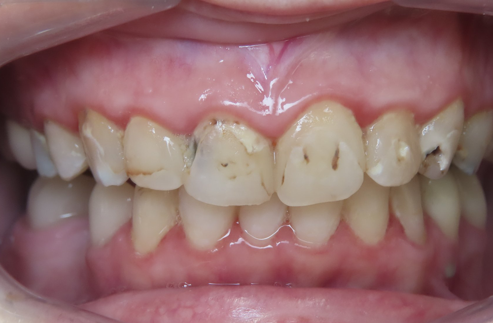 A close up of a person 's teeth with a lot of stains on them.