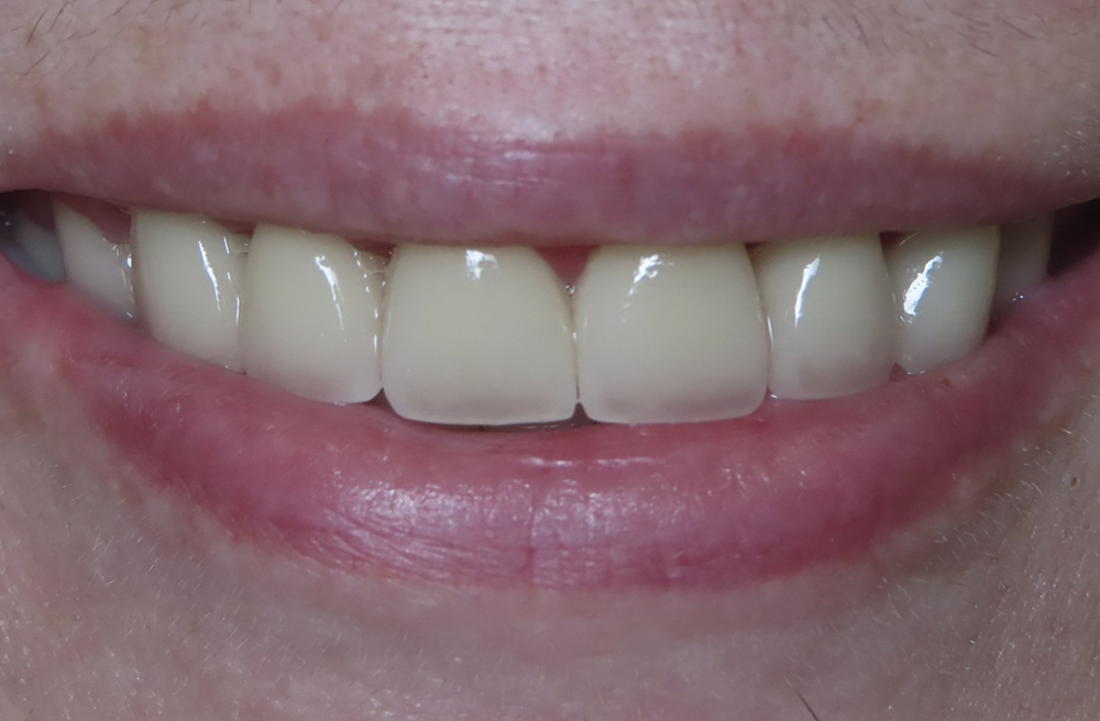 A close up of a woman 's smile with white teeth.