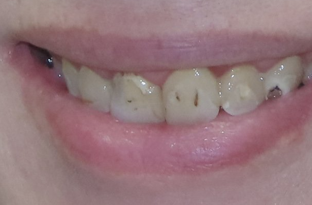 A close up of a woman 's smile with missing teeth.